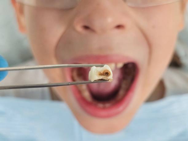Best Emergency Root Canal Therapy in Sughter, LA